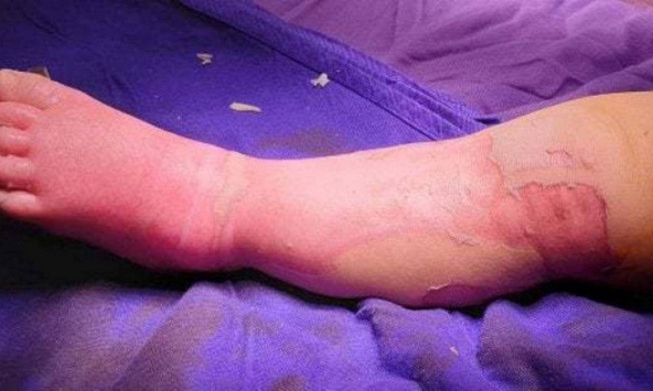 Bé trai 9 tháng tuổi tử vong vì đắp lá bà lang chữa bỏng