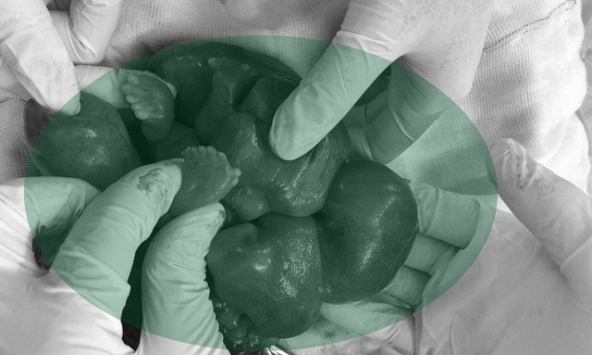 Hy hữu: Bào thai nằm trong bụng bé gái mới chào đời