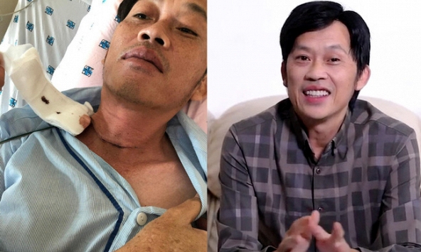 Nghệ sĩ Hoài Linh phẫu thuật vì bị u ác tuyến giáp cách đây vài tháng