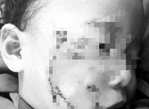 Một cháu bé 3 tuổi bị chó cắn nát mặt