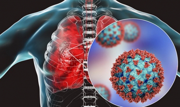 Nhiều trường hợp xuất hiện các bất thường trên phổi sau một năm khỏi Covid-19