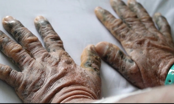 Người đàn ông bị bong tróc, sạm đen da vì uống thuốc tăng cường sinh lý