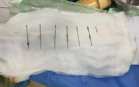 Thanh niên 28 tuổi tự đâm 7 cây kim khâu vào ngực 