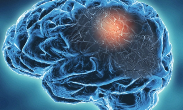 Mắc COVID-19 thể nặng khiến não già đi 20 tuổi, mất 10 điểm IQ