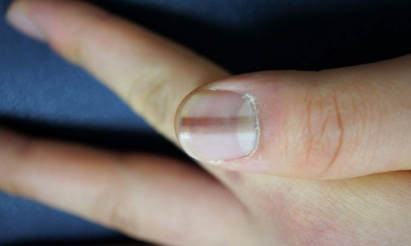 Dấu hiệu bất thường trên móng tay có thể cảnh báo ung thư da hiếm gặp