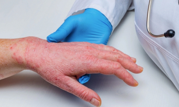 TP.HCM lên phương án giám sát bệnh đậu mùa khỉ