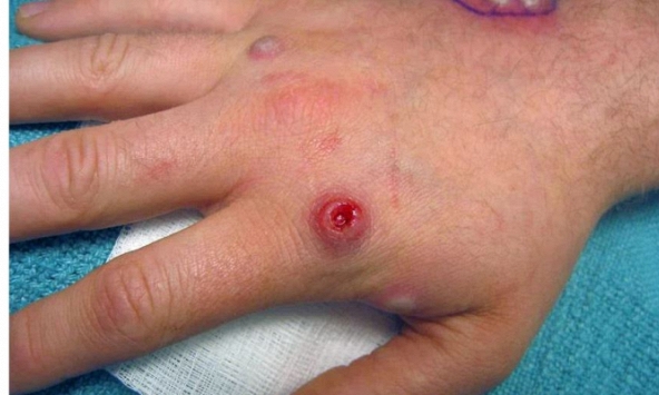 WHO thừa nhận sự lây lan 'bất thường' của virus đậu mùa khỉ