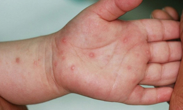 Trẻ bị tay chân miệng cần ăn uống ra sao để tăng sức đề kháng?