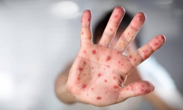 Dịch tay chân miệng tại Hà Nội đã vượt mốc 1.000 ca, khuyến cáo phụ huynh giữ vệ sinh cho con