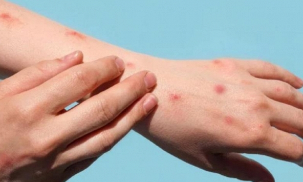 Những đối tượng nào cần tiêm chủng vaccine đậu mùa khỉ?