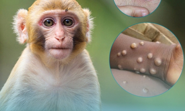 Bộ Y tế ban hành hướng dẫn chẩn đoán, điều trị và phòng bệnh đậu mùa khỉ