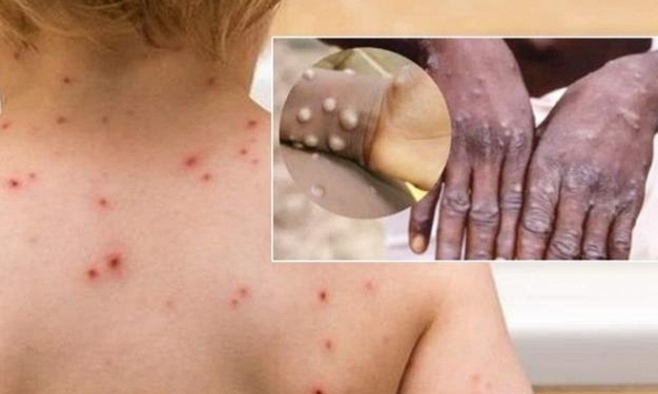 Mỹ phối hợp với Việt Nam phòng chống và kiểm soát dịch bệnh đậu mùa khỉ