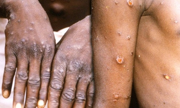 Ca tử vong đầu tiên do bệnh đậu mùa khỉ tại Tây Ban Nha