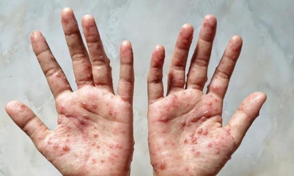 Hướng dẫn chẩn đoán, điều trị và phòng bệnh đậu mùa khỉ