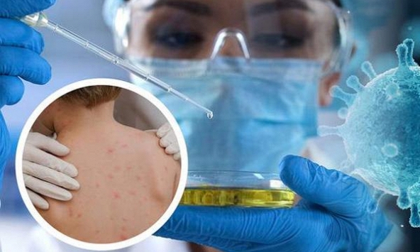 WHO nghiên cứu khả năng đột biến gene thúc đẩy đậu mùa khỉ lây lan