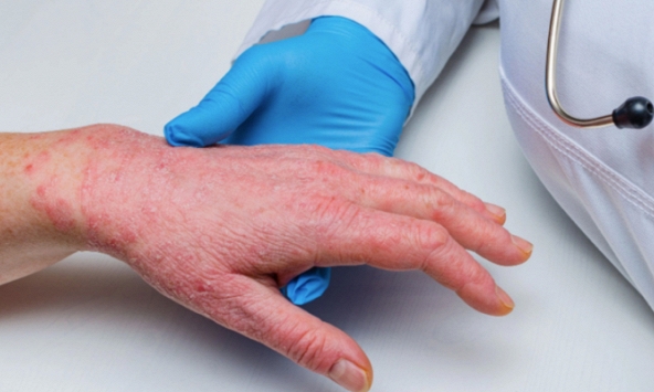 Bộ Y tế yêu cầu giám sát 21 ngày người nhập cảnh từ nơi có đậu mùa khỉ