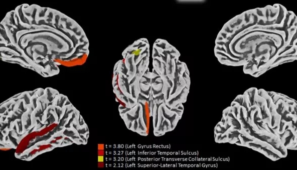Đã tìm ra cách COVID-19 tấn công não bộ: Lối ra cho người “mắc kẹt'?
