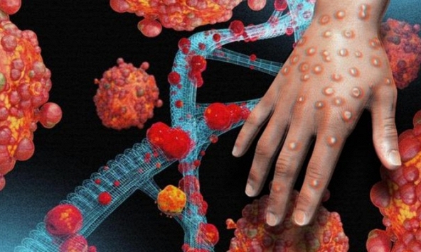 TP.HCM ghi nhận ca đậu mùa khỉ đầu tiên