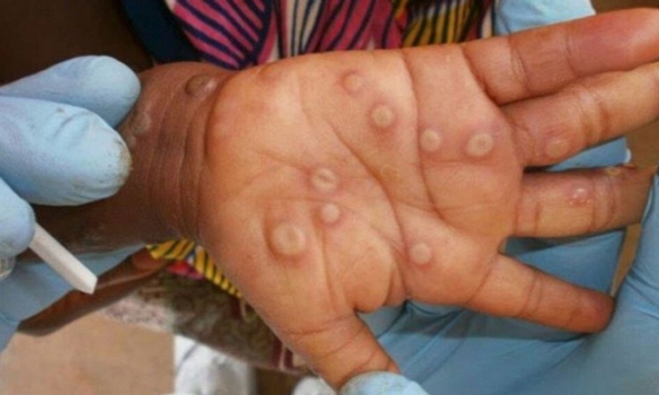 Một số điểm cần lưu ý về bệnh đậu mùa khỉ