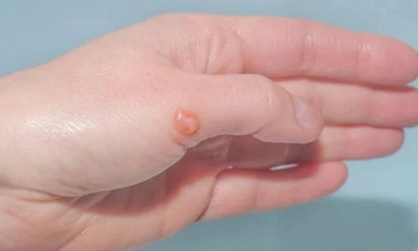 Virus đậu mùa khỉ đang tiến hóa?