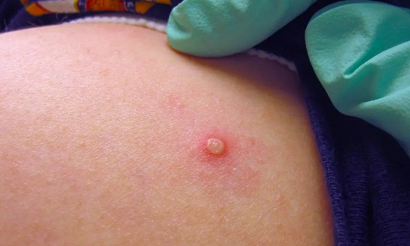 Việt Nam phát hiện ca đậu mùa khỉ thứ hai