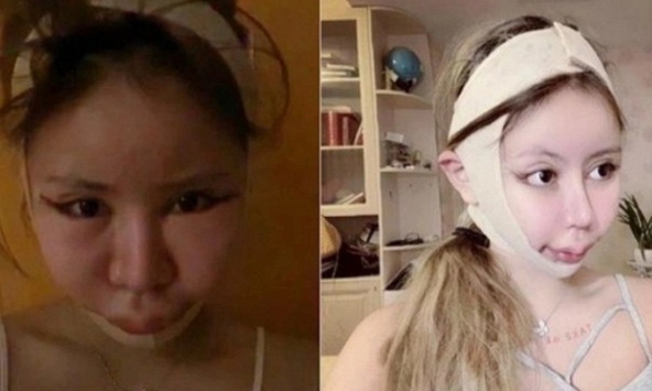 Bé gái 9 tuổi bị mẹ bắt cắt mí, làm mũi