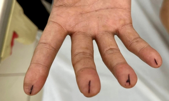 Nhập viện với vết dao lam cứa sâu vì làm theo 'thầy thuốc online'