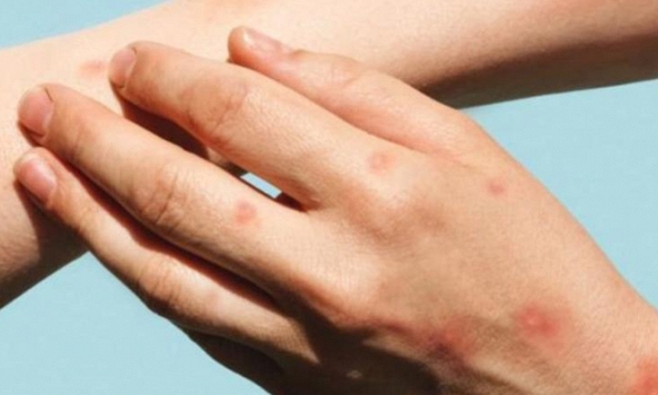 WHO: Bệnh đậu mùa khỉ không còn là tình trạng khẩn cấp y tế toàn cầu