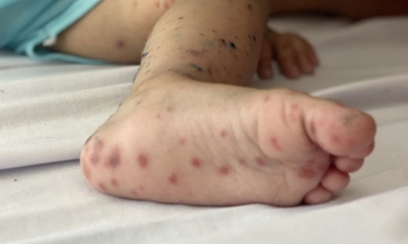 Virus Enterovirus 71 gây bệnh tay chân miệng nặng xuất hiện trở lại​