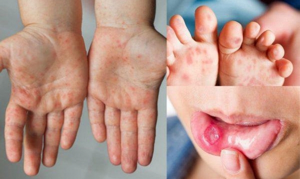 7 trẻ đã tử vong vì tay chân miệng 