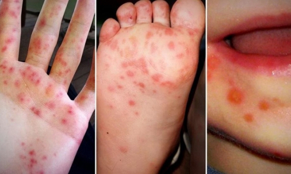 Phân bổ 6.000 chai thuốc trị tay chân miệng cho các bệnh viện