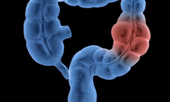 Thói quen xấu khiến nguy cơ mắc ung thư đại tràng tăng vọt: Nhiều người có mà không biết