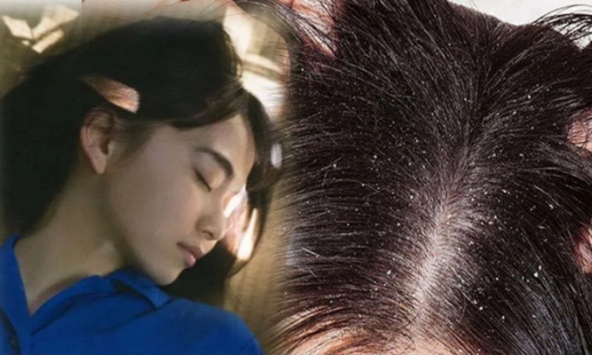 1 dấu hiệu ung thư da đầu rất giống với gàu, chủ quan bỏ qua dễ khiến bệnh nặng khó chữa