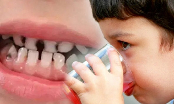 Bé trai 14 tuổi gần như mất cả hàm răng, phải dùng răng giả do nghiện một loại nước nhiều người yêu thích