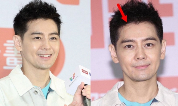 Lâm Chí Dĩnh lộ vết sẹo dài trên gương mặt cùng di chứng gần như mù sau vụ tai nạn nghiêm trọng