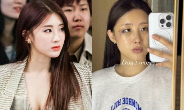 Nữ idol gợi cảm Hyuna phải phẫu thuật, bó bột vì tai nạn không ngờ