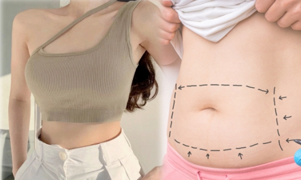 Phẫu thuật tạo hình thành bụng để có eo săn chắc, rãnh bụng sâu: 5 yếu tố tác động đến kết quả cuối cùng