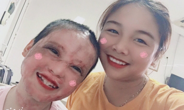 Câu chuyện về cô bé lớp 5 từng bị thiêu sống và nghị lực vươn lên nghịch cảnh sau 4 năm