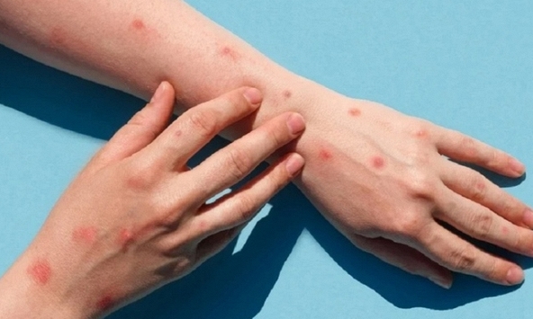 Bộ Y tế chỉ đạo không để lây nhiễm chéo bệnh đậu mùa khỉ