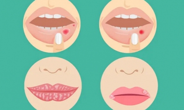 4 dấu hiệu bệnh nghiêm trọng có thể xuất hiện ở môi: Nếu thấy cần đi khám ngay
