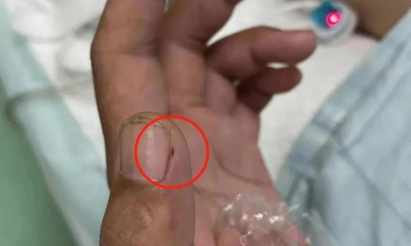 Bị viêm màng não nguy kịch vì cách sơ chế thịt lợn sai nhiều người mắc