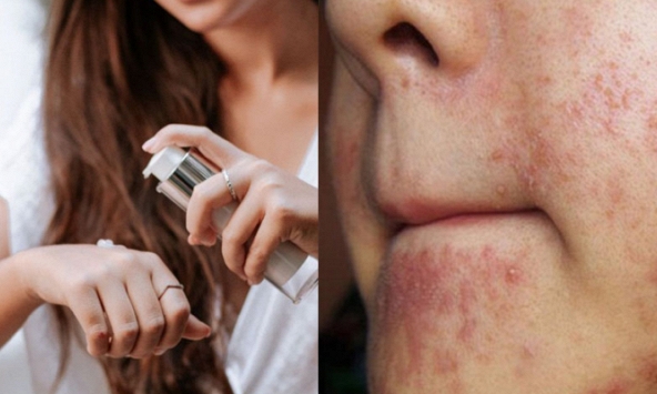 Sẽ thế nào nếu bạn lạm dụng retinol để chống lão hóa da?