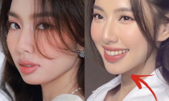 Hoa hậu Thuỳ Tiên vướng nghi vấn 'dao kéo', bị soi điểm khác lạ trên gương mặt