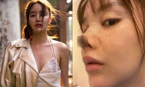 Nữ diễn viên biến chứng “dao kéo” kinh hoàng đến mức mất loạt vai diễn, cảnh báo chị em tránh xa 1 điều sau trải nghiệm đau đớn