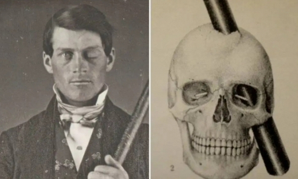 Người đàn ông bị thanh sắt đâm xuyên đầu vẫn sống khỏe nhưng đổi hoàn toàn nhân cách, bí mật khám phá sau đó tạo nên cách mạng ngành y