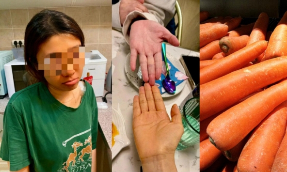 Ăn cà rốt liên tục 3 tháng để giảm cân, cô gái da chuyển vàng như nghệ