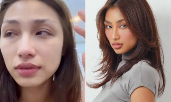 Top 10 Hoa hậu Hoàn vũ tiết lộ gần 1 năm chống chọi với nhược thị, tình hình hiện tại thế nào?