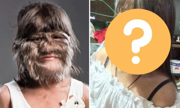 'Cô bé người sói' mắc chứng bệnh lạ cả thế giới chỉ có 50 người từng bị giờ ra sao ở tuổi trưởng thành?