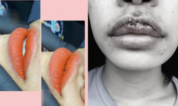 Chi 35 triệu phun môi trái tim, 'sản phẩm' nhận về khiến ai nhìn thấy cũng 'hốt hoảng'