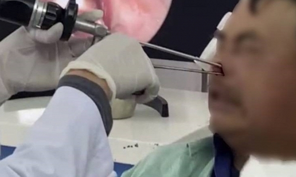 Gắp hơn 100 con giòi làm tổ trong hốc mũi bệnh nhân 53 tuổi